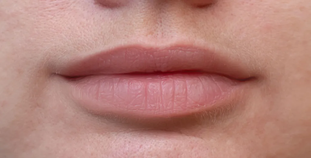 Trattamento Filler dopo