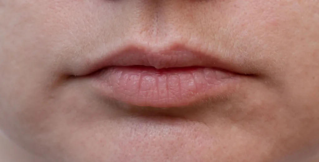 Trattamento Filler prima