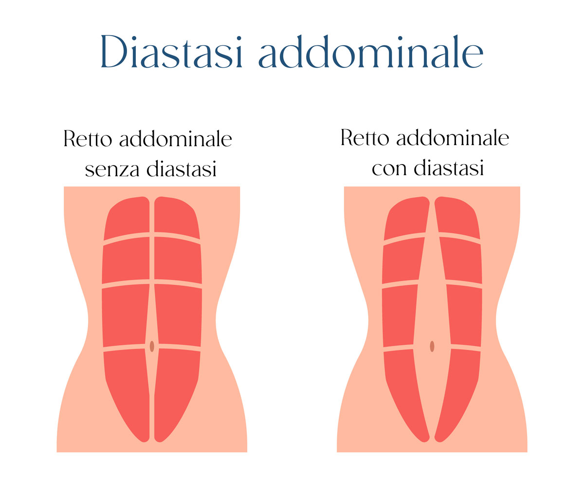 Diastasi addominale