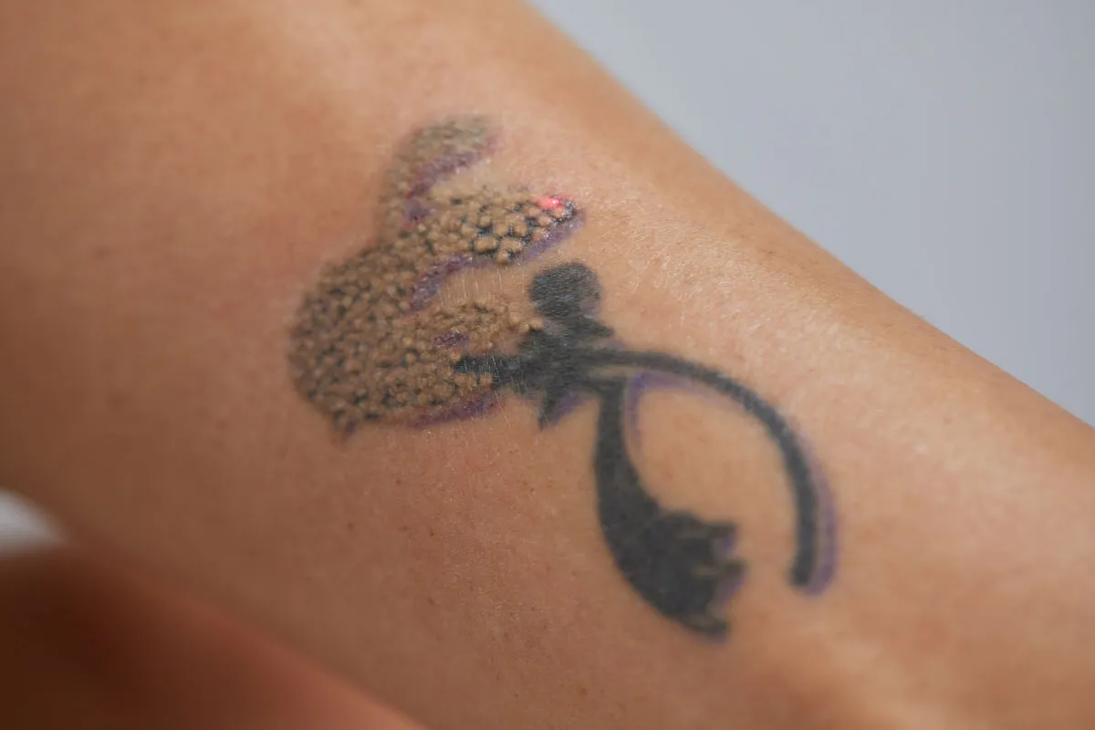 Rimozione Tatuaggi Senza Cicatrici