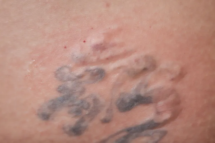 trattamento rimozione tatuaggi