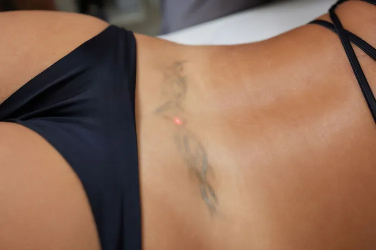 rimozione tatuaggi costo