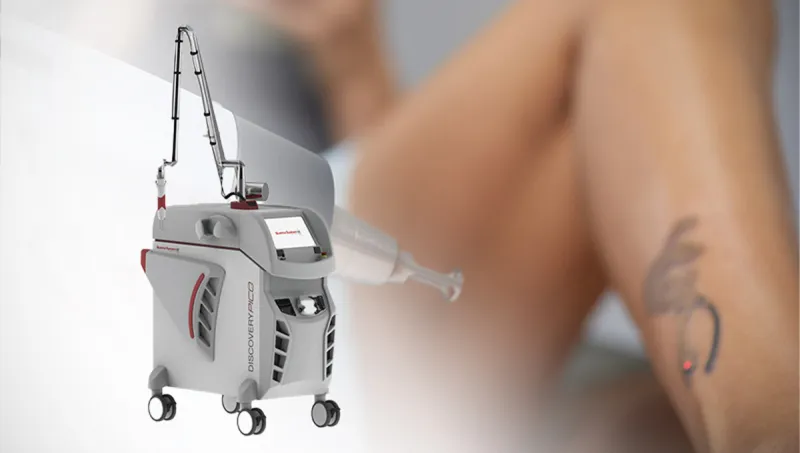 miglior laser per la rimozione dei tatuaggi
