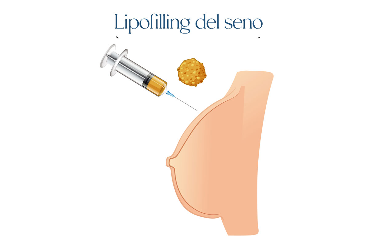 lipofilling seno