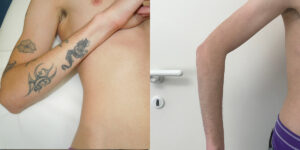 rimozione tatuaggi prima e dopo marco braccio