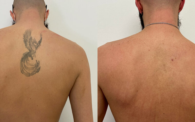 rimozione tatuaggi prima e dopo Francesco schiena