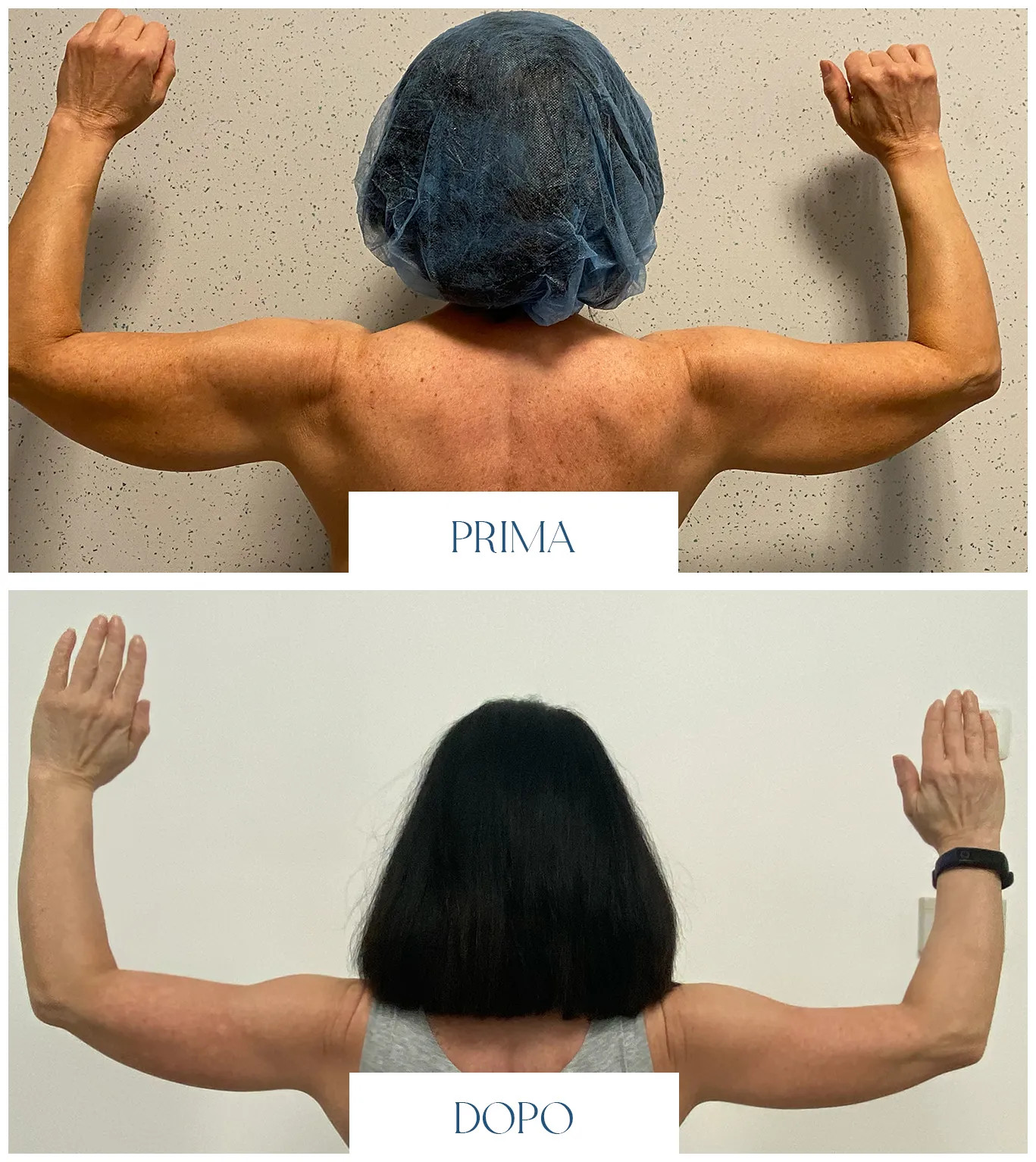 Braccia flaccide prima e dopo il lifting: secondo confronto fotografico