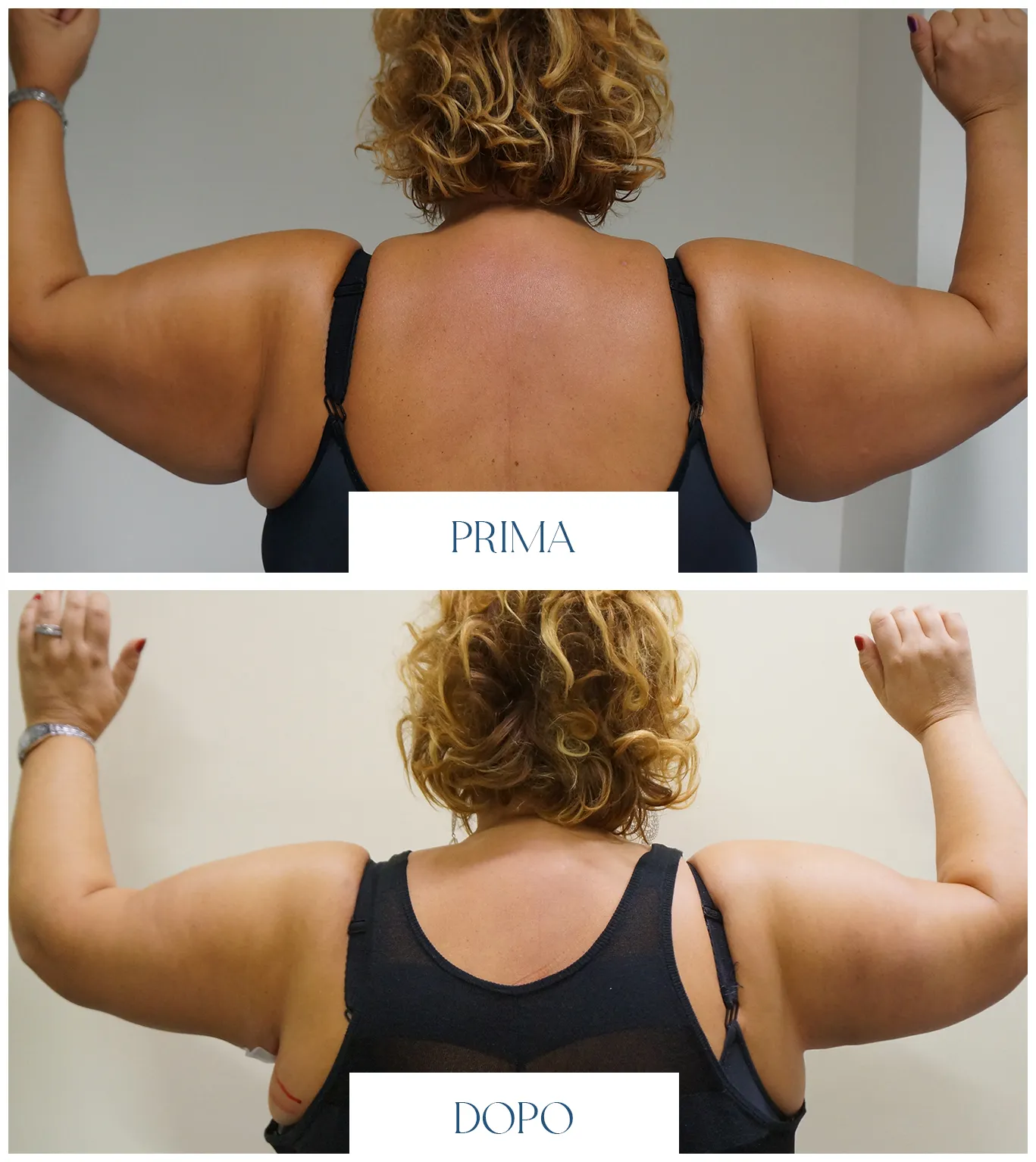 Prima e dopo la brachioplastica: terzo confronto fotografico