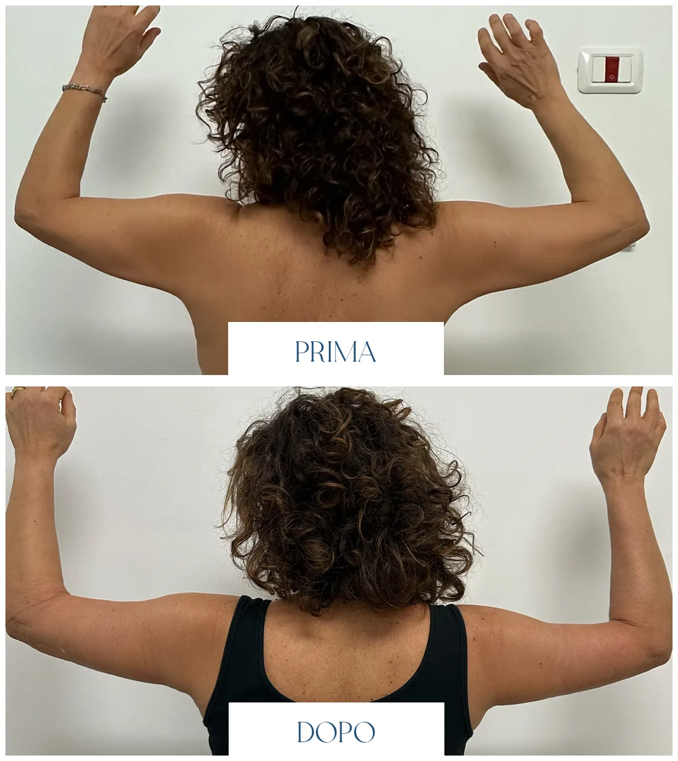 Lifting delle braccia prima e dopo: primo confronto fotografico