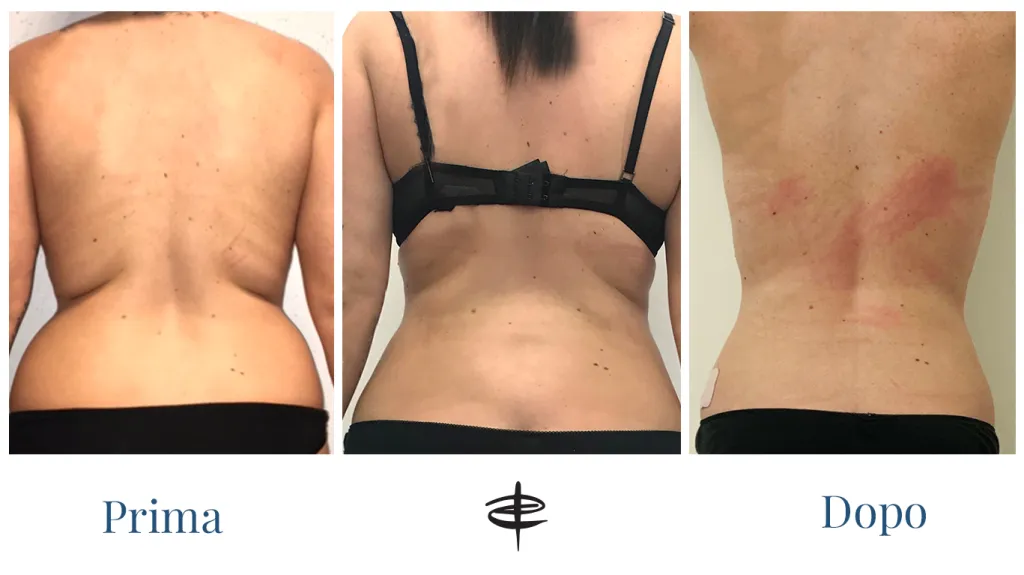 Liposuzione donna prima dopo