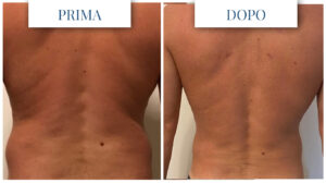 Liposuzione uomo prima dopo