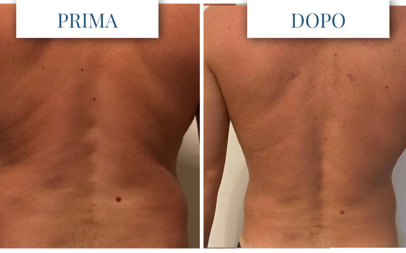 Liposuzione uomo prima dopo