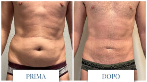 Liposuzione uomo pancia prima dopo