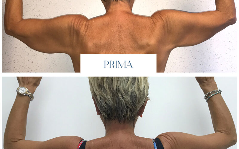lifting braccia prima dopo Laura