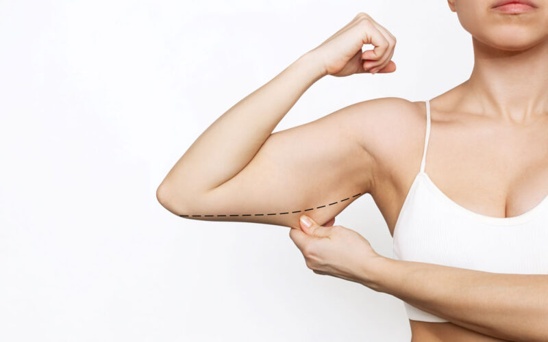 Lifting braccia flaccide: eliminare il grasso in eccesso e tonificare