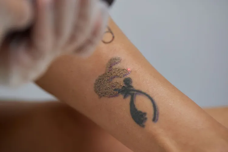 Impossibile rimuovere tatuaggio