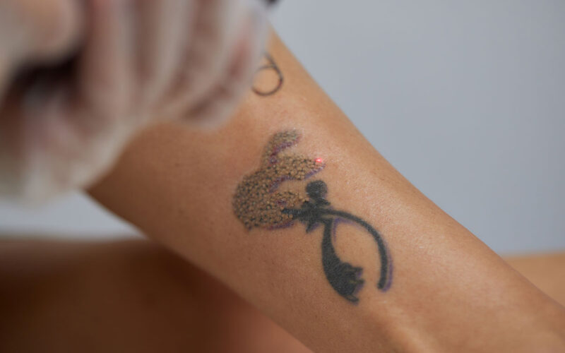 Impossibile rimuovere tatuaggio