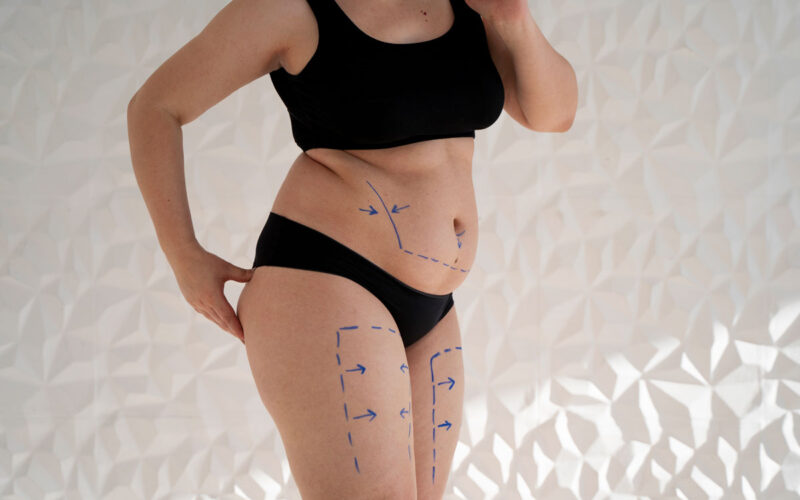 Liposuzione post parto? Tornare in forma dopo la gravidanza