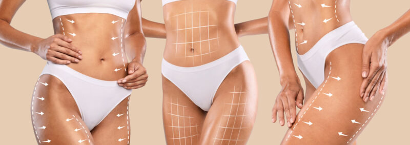 liposuzione e lipofilling