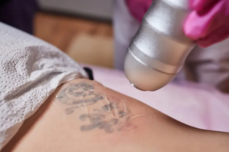 trattamenti dopo la rimozione dei tatuaggi