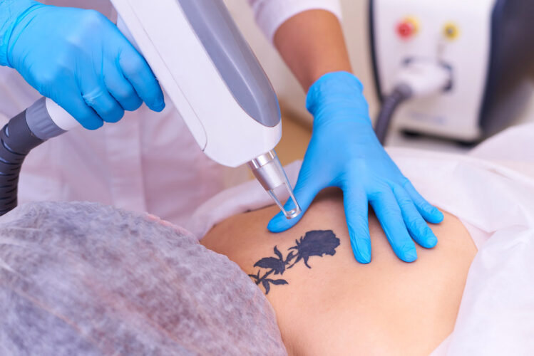 Laser Q-Switched nella rimozione dei tatuaggi