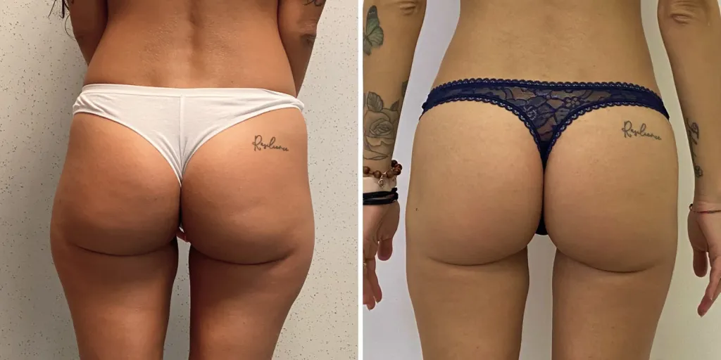 lipofilling glutei prima e dopo