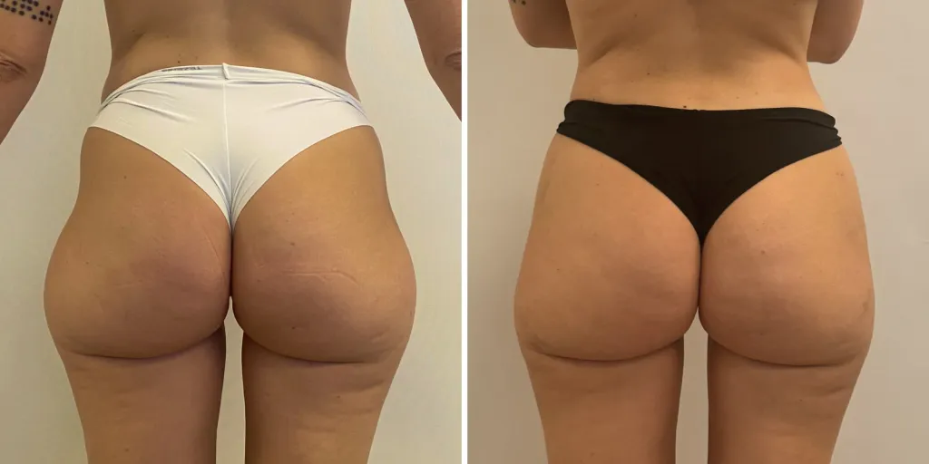 lipofilling glutei prima e dopo