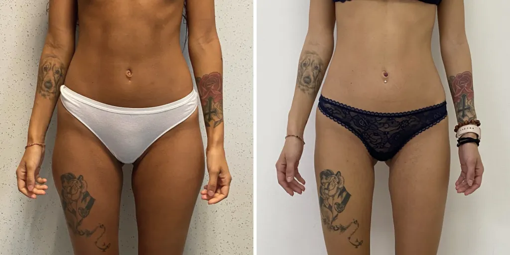 liposuzione fianchi prima e dopo