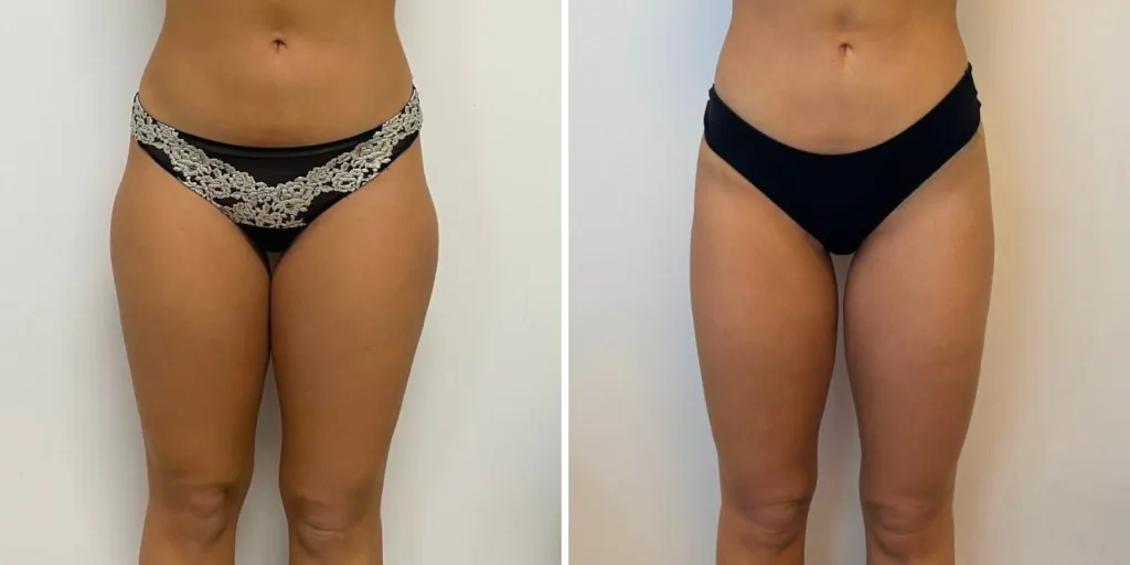 liposuzione prima e dopo