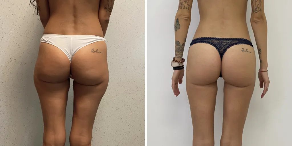 liposuzione prima e dopo