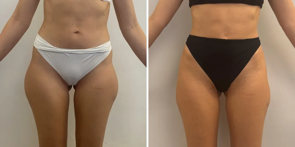 liposuzione prima e dopo