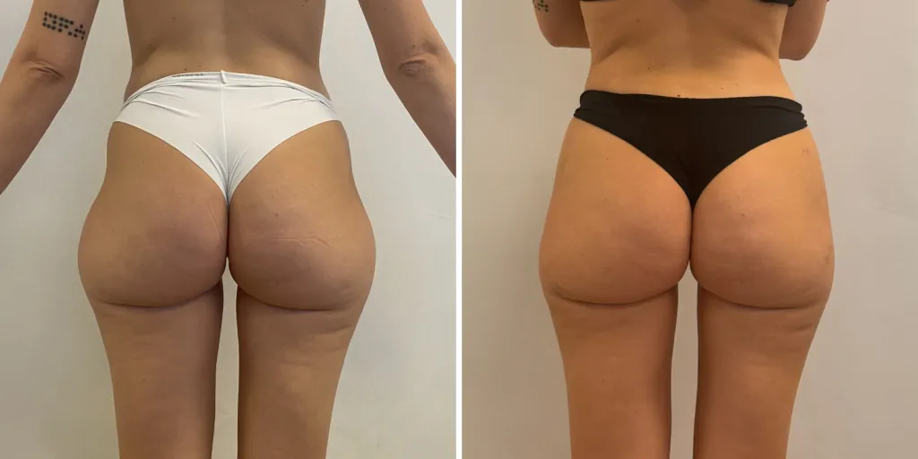 liposuzione prima e dopo