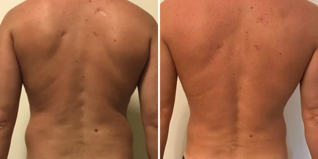 liposuzione schiena prima e dopo