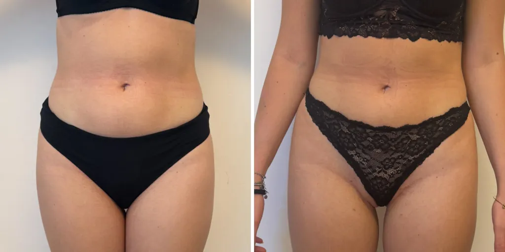 liposuzione prima e dopo