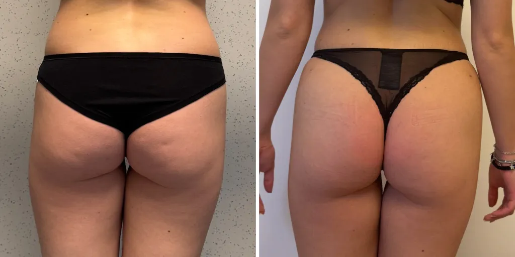 liposuzione prima e dopo