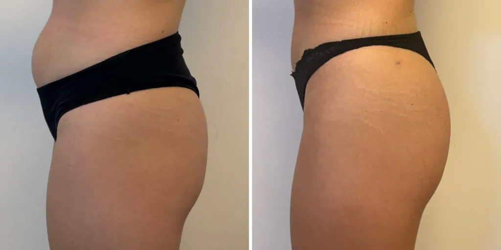 liposuzione prima e dopo