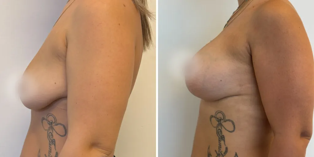 mastopessi prima e dopo