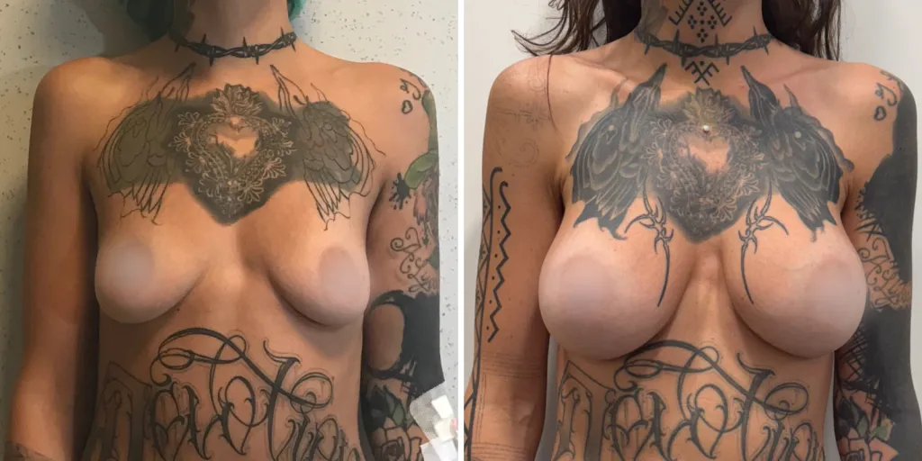 mastoplastica prima e dopo