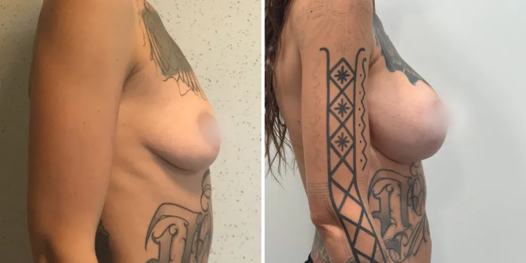 mastoplastica prima e dopo