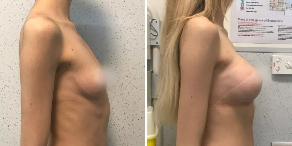 mastoplastica prima e dopo