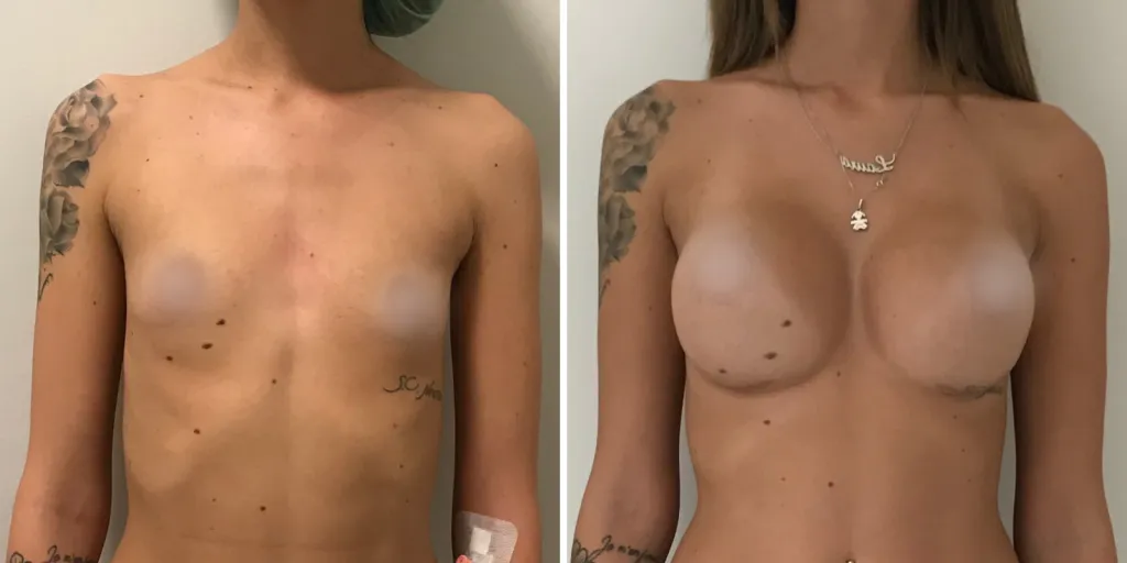 mastoplastica prima e dopo