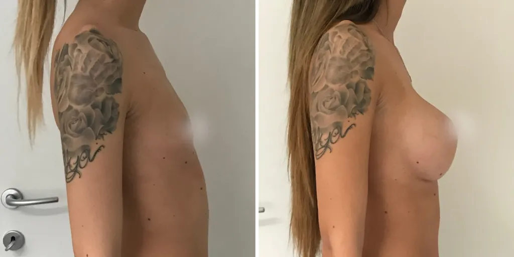mastoplastica prima e dopo