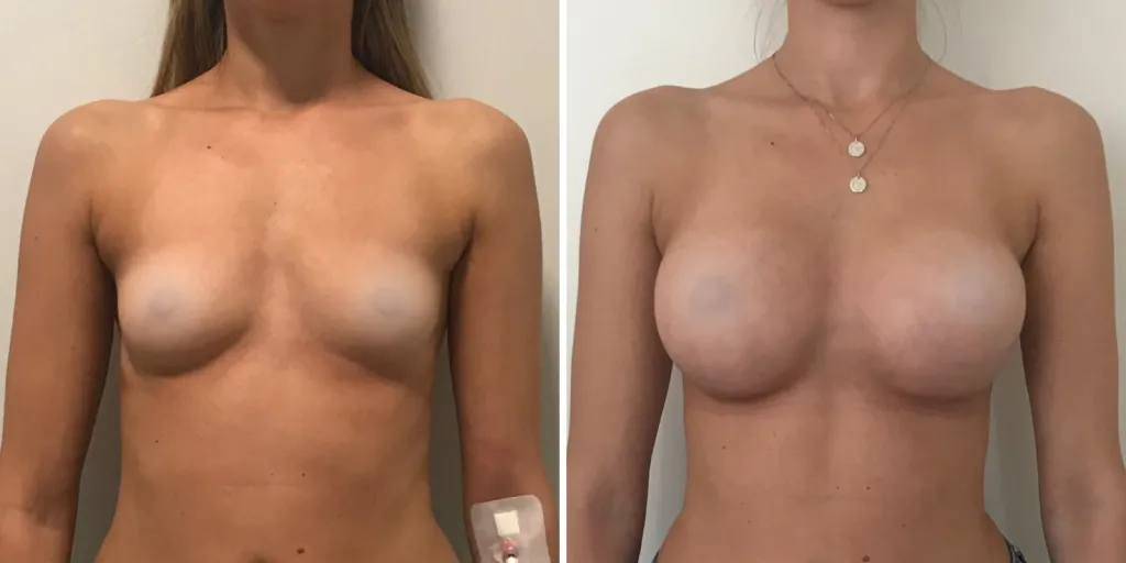 mastoplastica prima e dopo