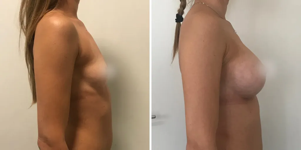 mastoplastica prima e dopo