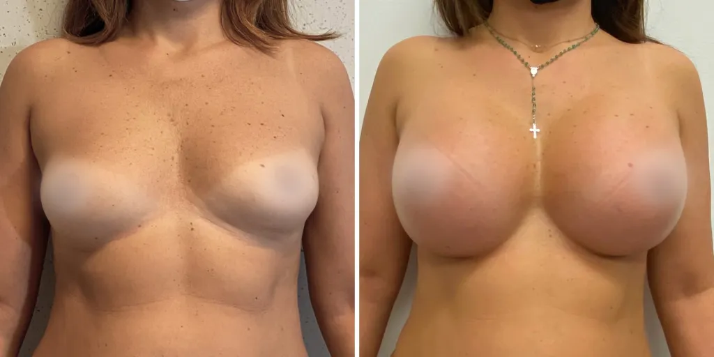 mastoplastica prima e dopo