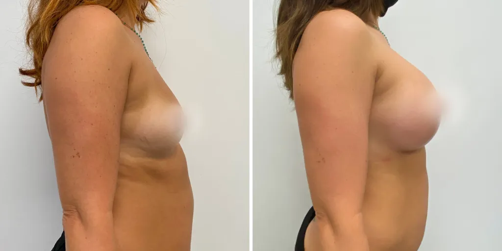 mastoplastica prima e dopo