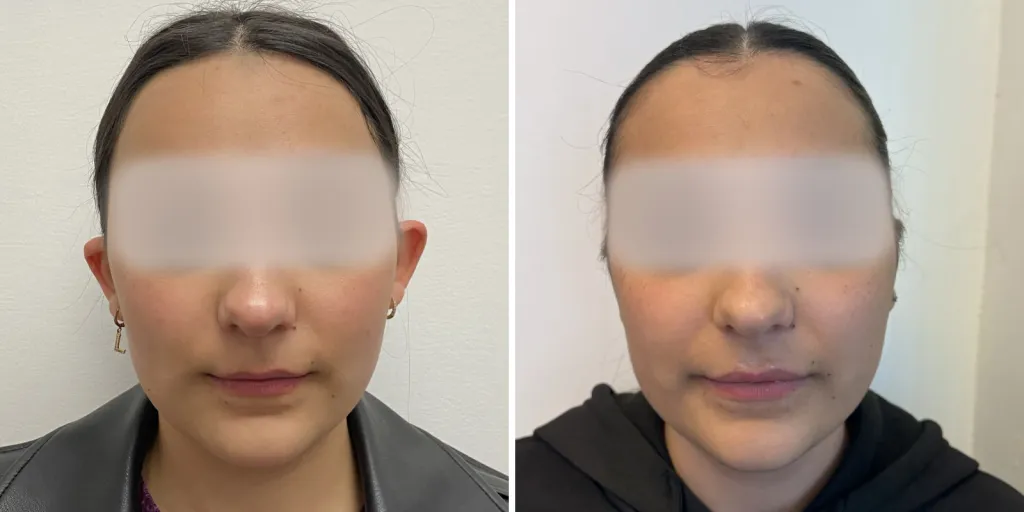 otoplastica prima e dopo