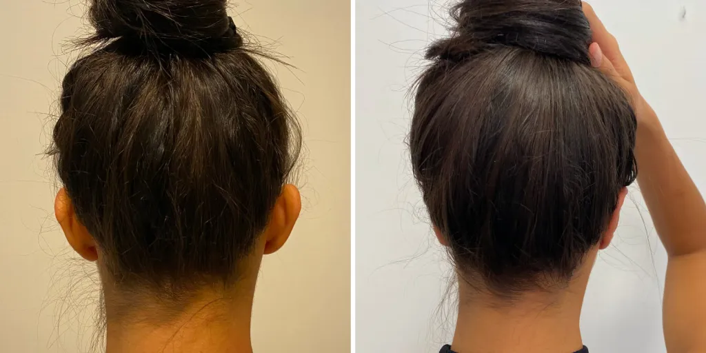 otoplastica prima e dopo