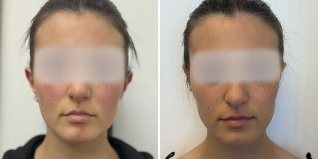 otoplastica prima e dopo