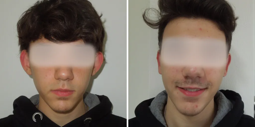 otoplastica prima e dopo